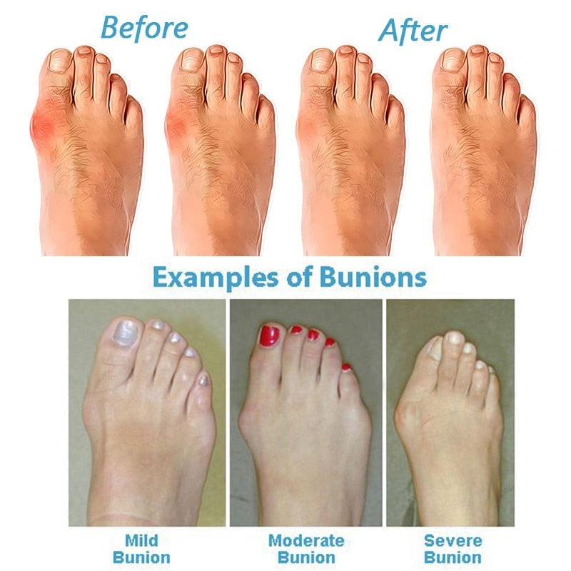 Relief | Orthopedic Correcting Sandals Women - TARHUS