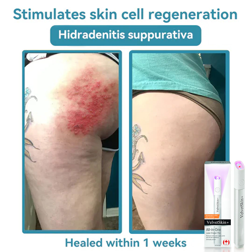 VelvetSkin Laser Eraser Pen | Remove Moles, Warts & Dark Spots Safely TARHUS ENN-VHH