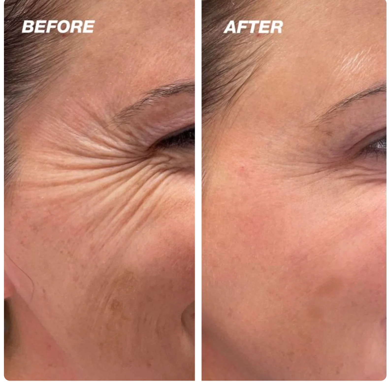 Face Lifting & Anti-Wrinkle Tape – Reusable Botox Tape for Firm, Smooth Skin