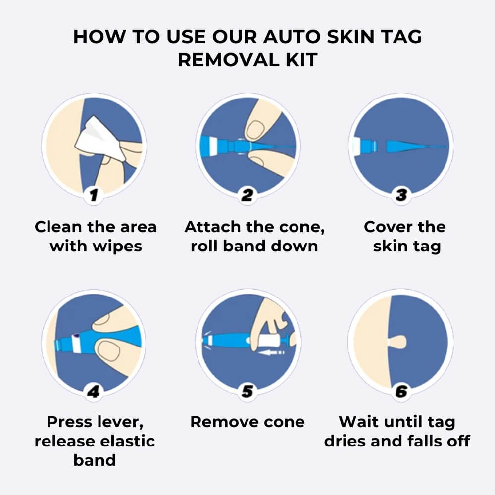 Auto Skin Tag Removal Kit