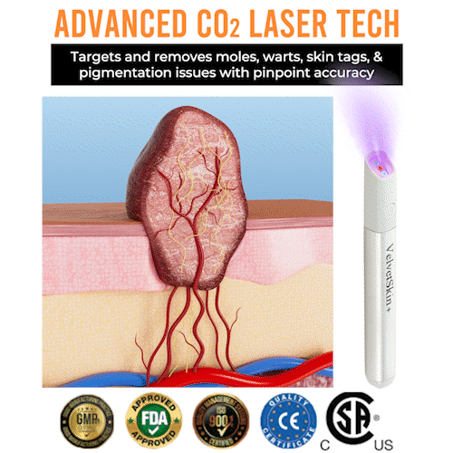 VelvetSkin Laser Eraser Pen | Remove Moles, Warts & Dark Spots Safely TARHUS  ENN-VHH